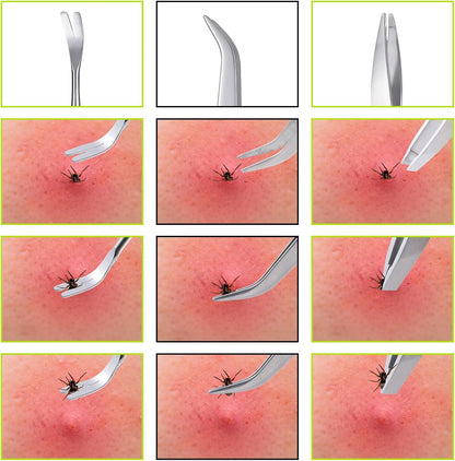 3 in 1 Tick Remover Kit, 3 Pack Stainless Steel Tick Tweezers, Ticks Fork and Portable Storage Case for Cats and Dogs